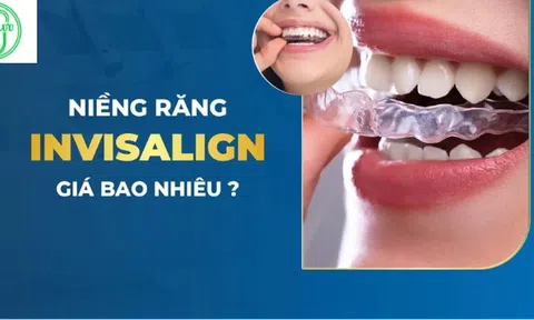 Niềng răng có tốt hay không?