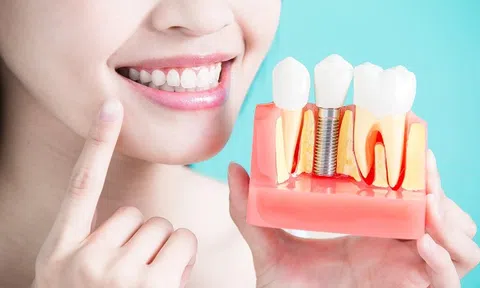 Những điều cần biết về trồng răng implant