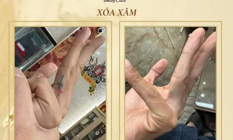 Vì sao nhiều người chọn xóa hình xăm?