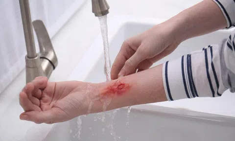 Phòng khám gia đình Việt - Úc: Tầm quan trọng của việc rửa vết thương đúng cách