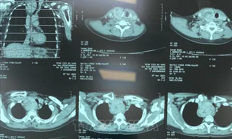 Quyết định mới của Bộ Y tế: Chẩn đoán hình ảnh không cần phim in vào Quỹ BHYT chi trả