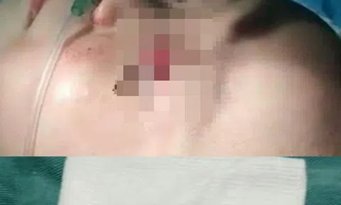 Cây đinh "khủng" đâm vào mắt bé gái ở Nghệ An
