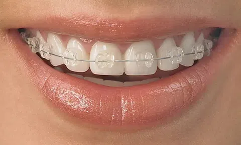 Niềng răng mắc cài sứ có tốt hơn mắc cài kim loại không?