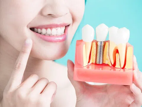 Những điều cần biết về trồng răng implant